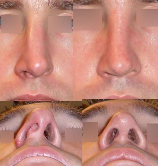 Remodeler un nez dévié avec une opération de chirurgie esthétique du nez, Paris 75000
