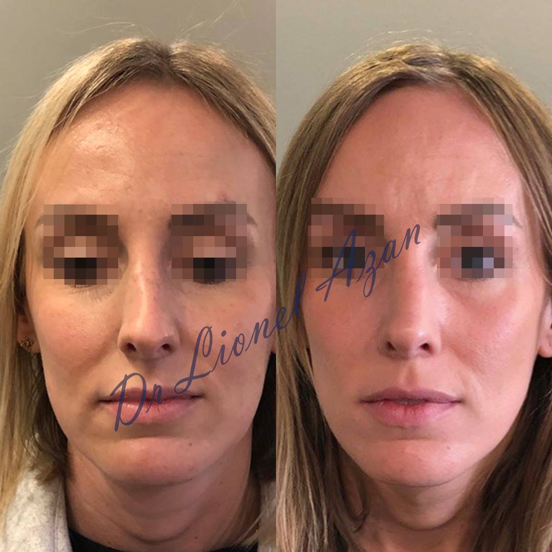 resultat rhinoplastie dr lionel azan 