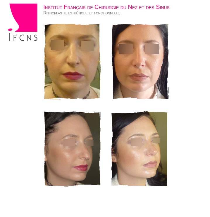 Chirurgien à Lyon en Rhône-Alpes pour faire une septoplastie