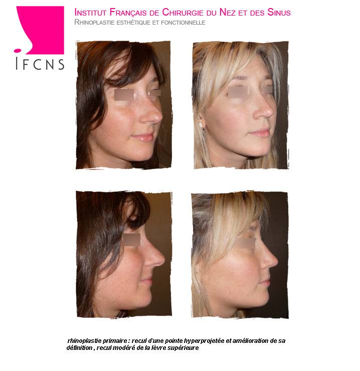 Chirurgie en rhinoplastie ethnique pour un nez asiatique à Paris en Île-de-France