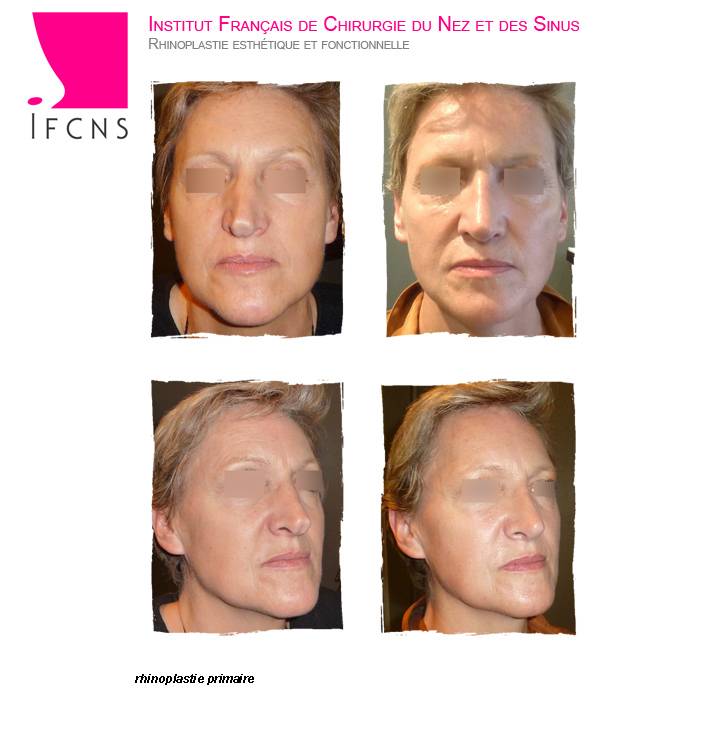 rhinoplastie secondaire apres echec de rhinoplastie primaire , resultat avant apres , Nantes