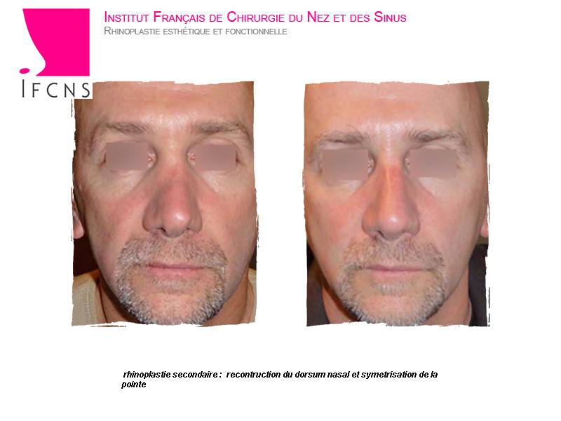 Résultat avant après rhinoplastie secondaire ou reparatrice et fonctionnelle avec greffe de cartilage , Bruxelles