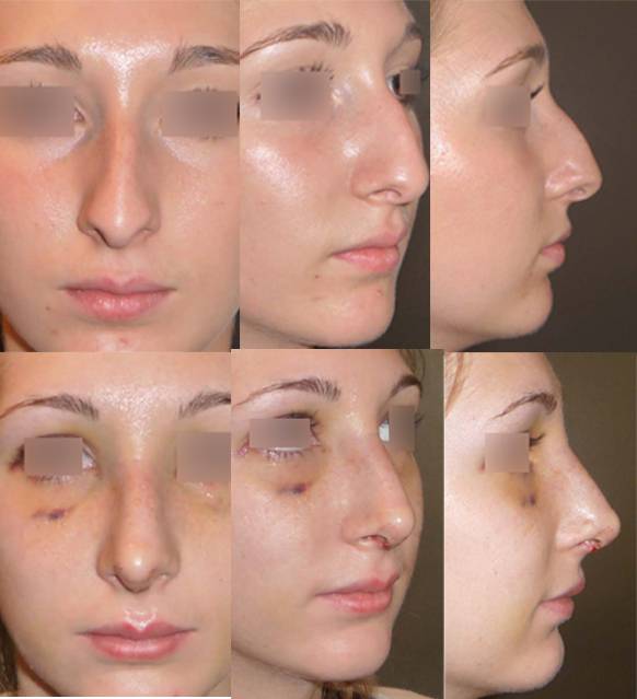  rhinoplastie resultat a 7 jours paris 