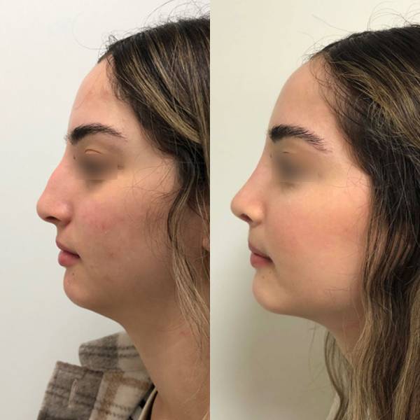 rhinoplastie esthetique avant apres dr azan