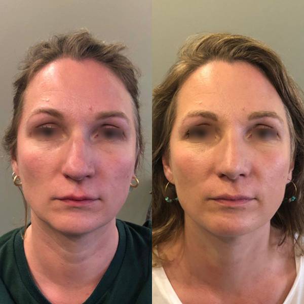 rhinoplastie avant apres paris dr azan