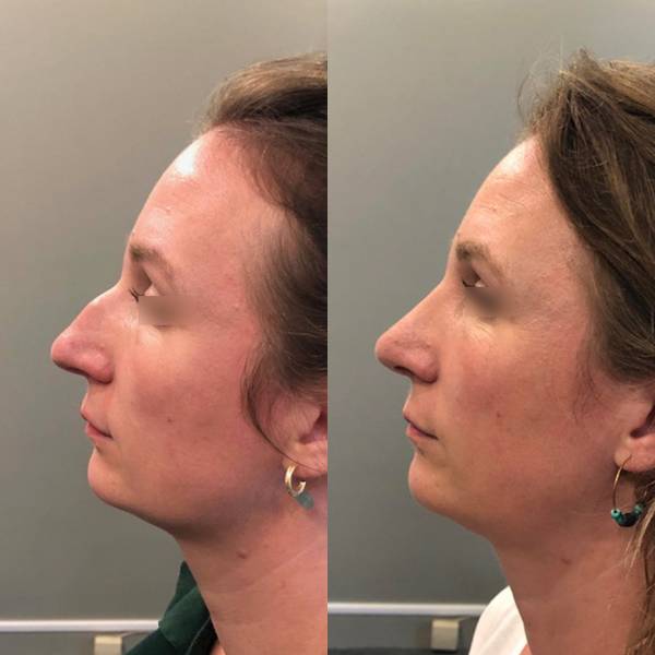 rhinoplastie avant apres paris dr azan