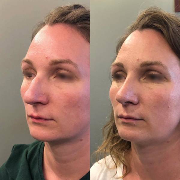 rhinoplastie avant apres paris dr azan