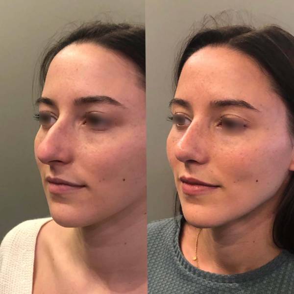 rhinoplastie avant apres paris