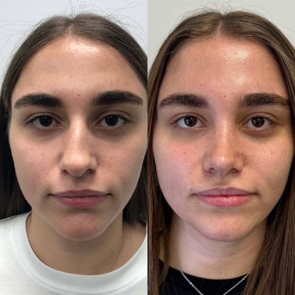 resultat rhinoplastie avant apres dr susini paris