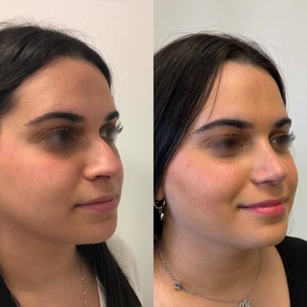 resultat rhinoplastie avant apres dr azan 