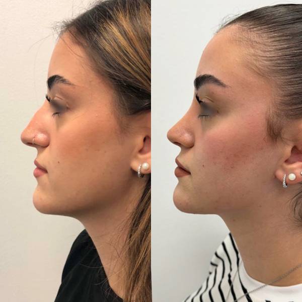 resultat rhinoplastie avant apres dr azan