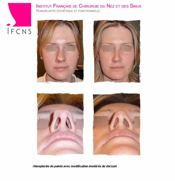 Correction de la pointe du nez avec une opération de chirurgie esthétique, Lille 59000