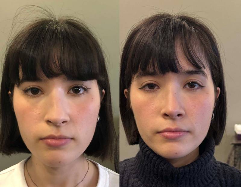 rhinoplastie esthetique dr azan paris