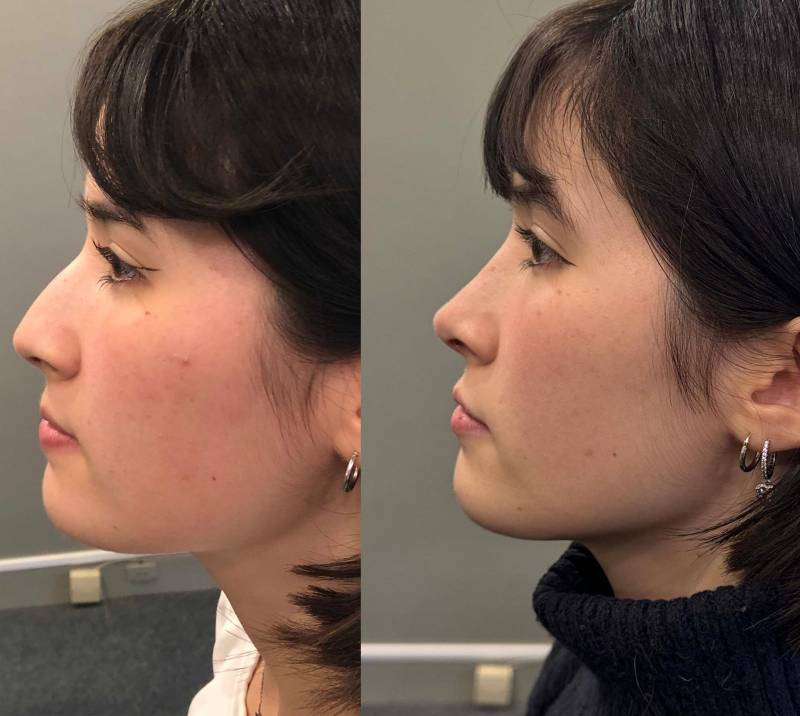 rhinoplastie esthetique dr azan paris