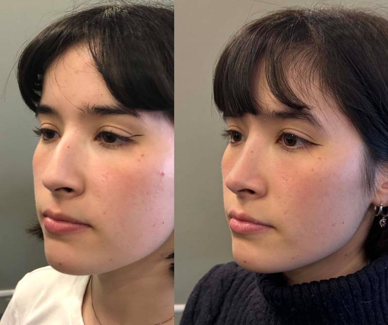 rhinoplastie esthetique dr azan paris
