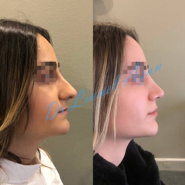 rhinoplastie medicale