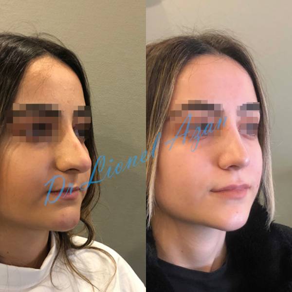 acide hyaluronique rhinoplastie