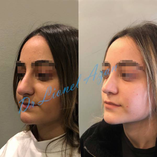 rhinoplastie avant apres paris