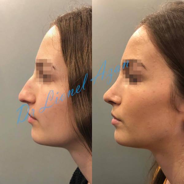 resultat rhinolastie ultrasonique paris