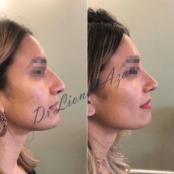 rhinoplastie sur peau grasse reduction narinaire