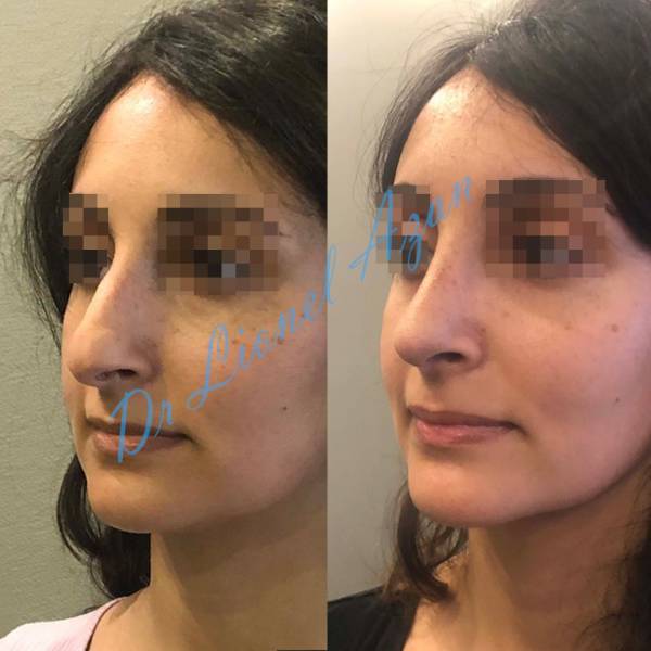 rhinoplastie avant apres paris