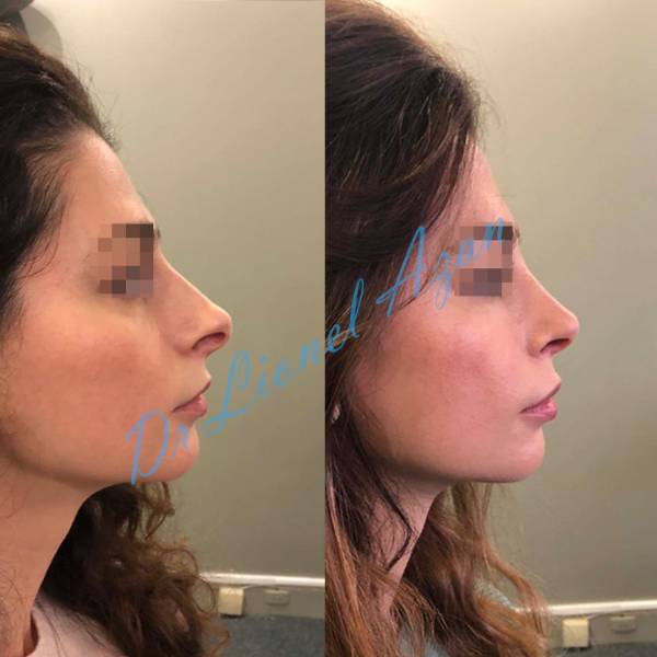 rhinoplastie resultat avant apres  paris