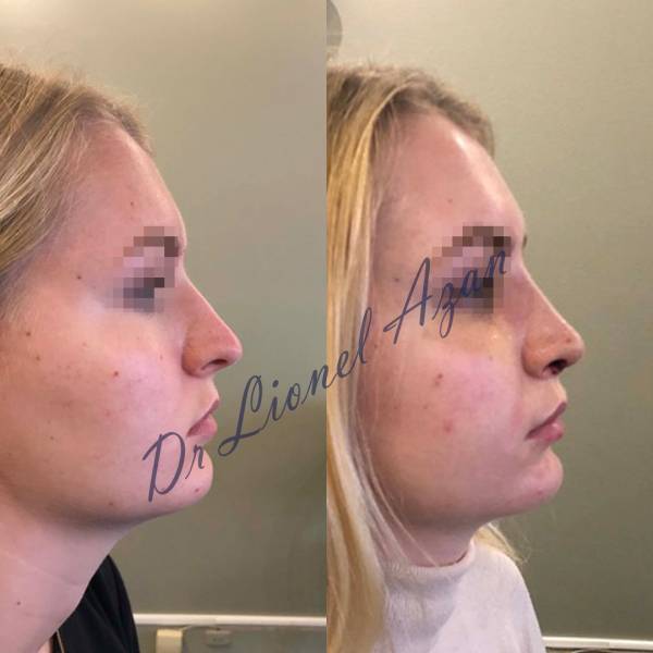 resultat rhinoplastie avant pares lille