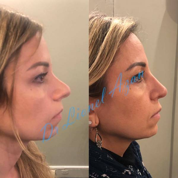 preservation rhinoplastie paris