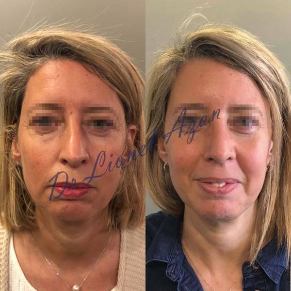 resultat rhinoplastie dr azan paris