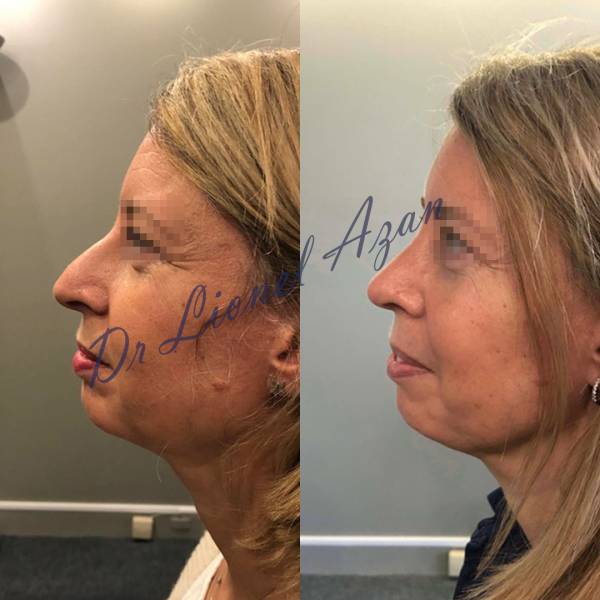 resultat rhinoplastie dr azan paris