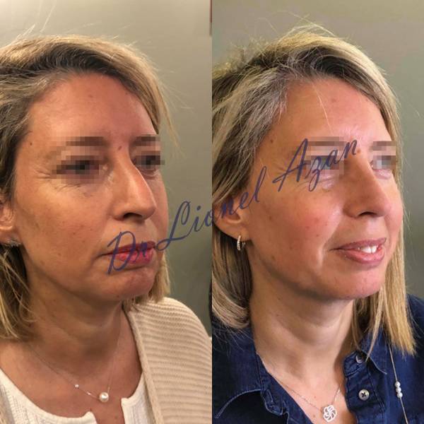 resultat rhinoplastie dr azan paris 