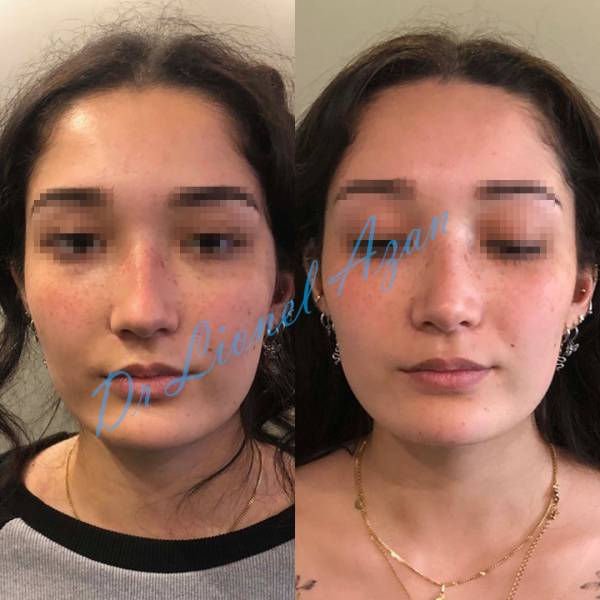 resultat rhinoplastie avant apres paris dr azan