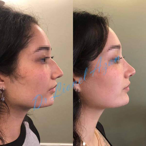 resultat rhinoplastie avant apres paris dr azan