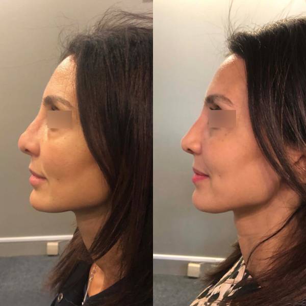 rhinoplastie seconadaire tel aviv