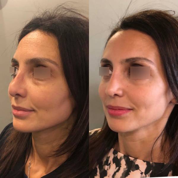 rhinoplastie secondaire dr lionel azan