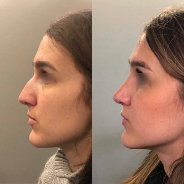 rhinoplastie specialiste paris dr aza