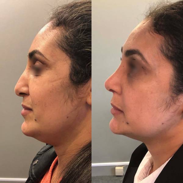 resultat rhinoplastie paris