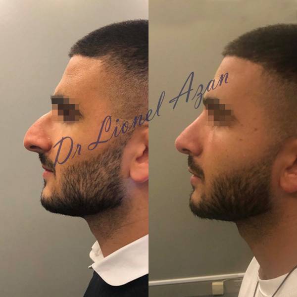 resultat rhinoplastie avant apres paris dr azan