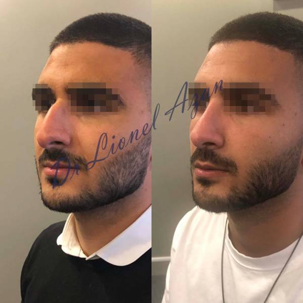 resultat avant apres rhinoplastie paris