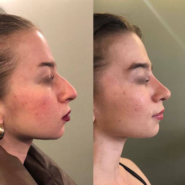 specialiste ehinoplastie dr azan