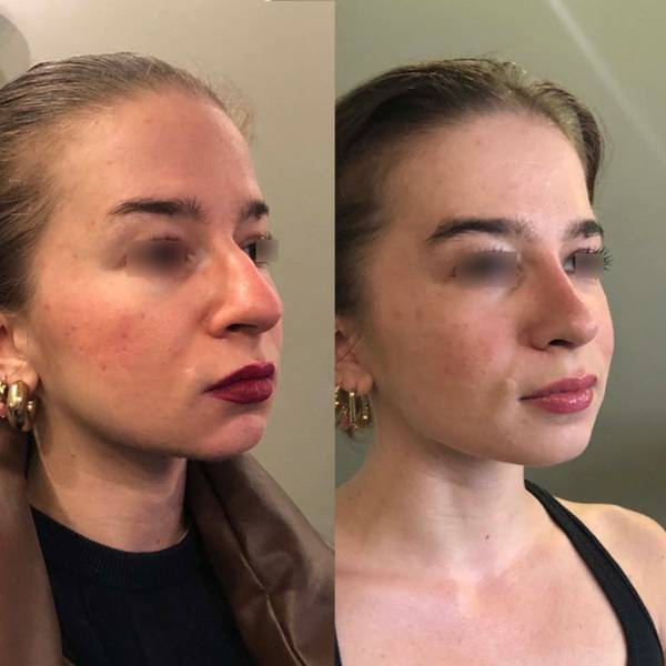 reduction narinaire dr azan