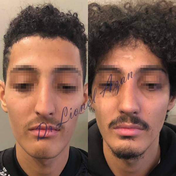 resultat rhinoplastie dr azan paris