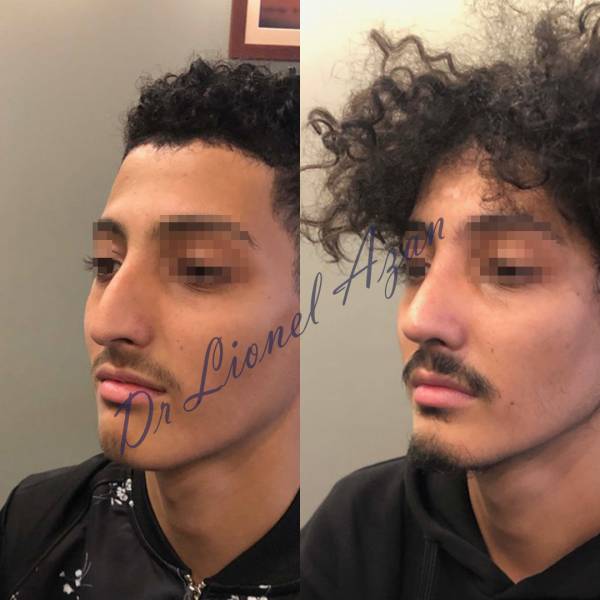 resultat rhinoplastie dr azan paris