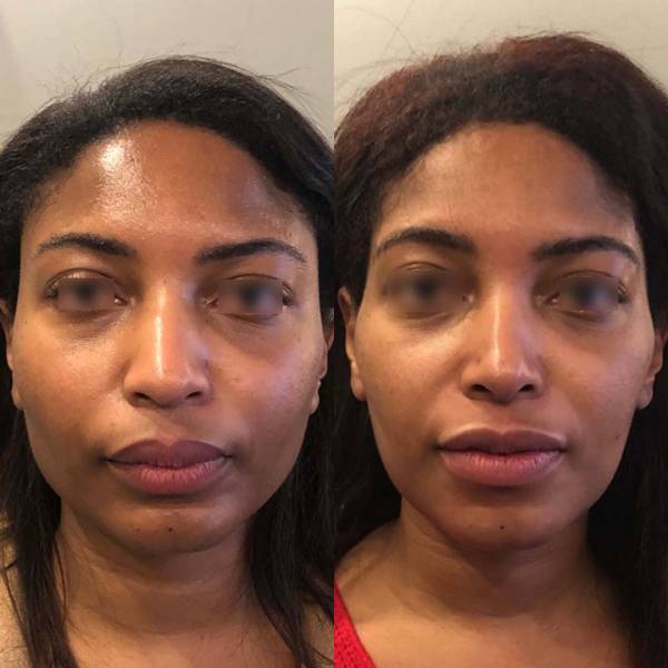 rhinoplastie ethnique paris dr azan