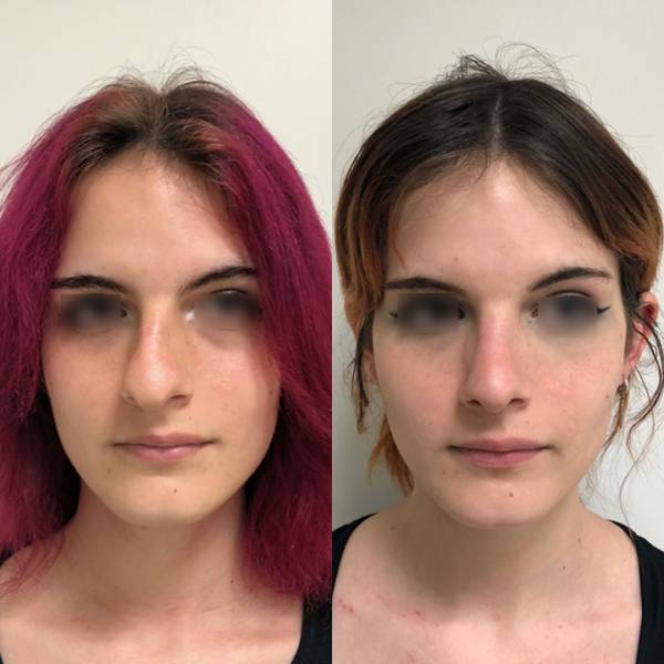 meileurs chirurgien rhinoplastie paris