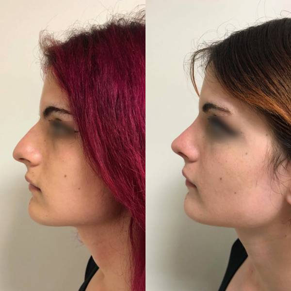 rhinoplastie avant apres dr lionel azan