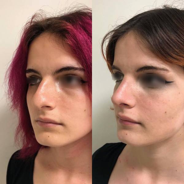 rhnoplastie avant apres paris