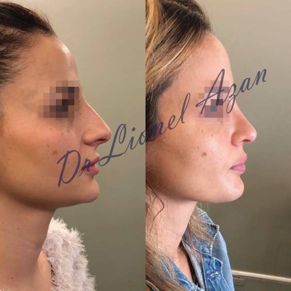 resultat rhinoplastie paris ultrasonique