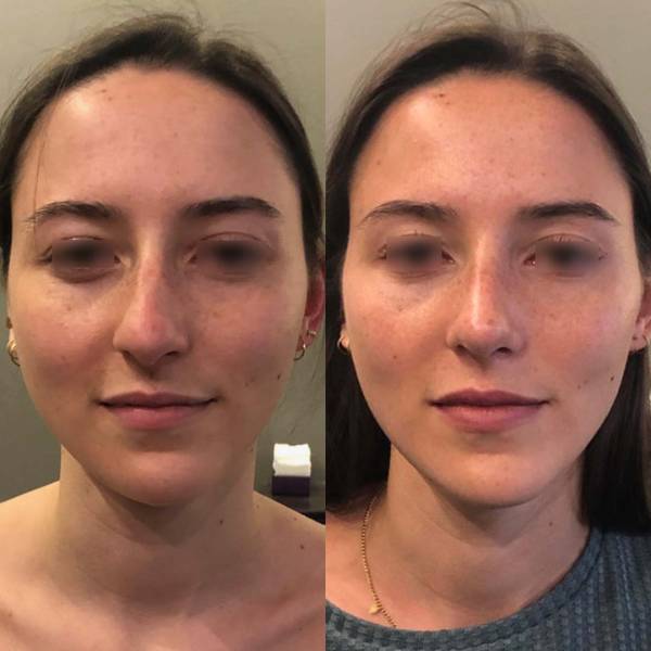 rhinoplastie avant apres paris