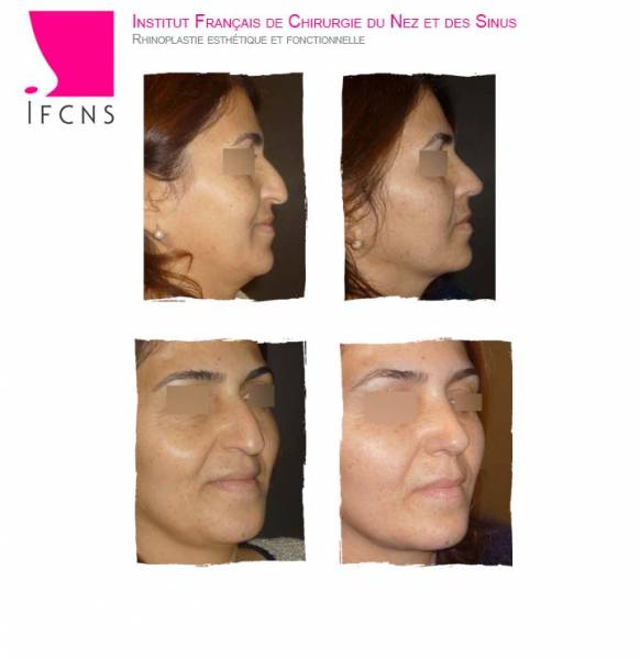 Remonter une pointe de nez  tombante avec une rhinoplastie, résultat avant apres , Geneve